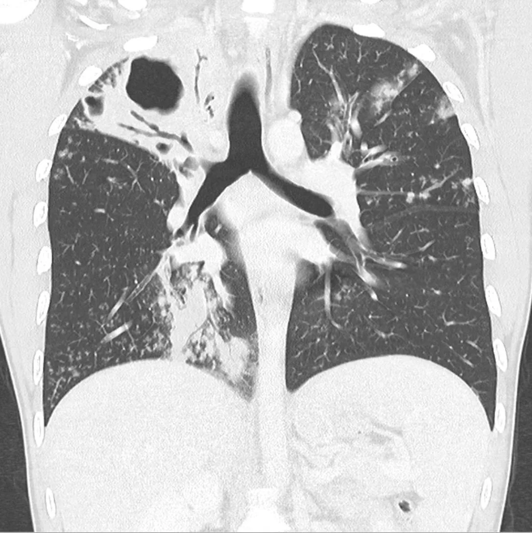 Tuberkulose – CT koronar: floride kavernisierende Tuberkulose mit dickwandiger Kaverne im rechten Oberlappen und fleckigen Herden in beiden Lungen