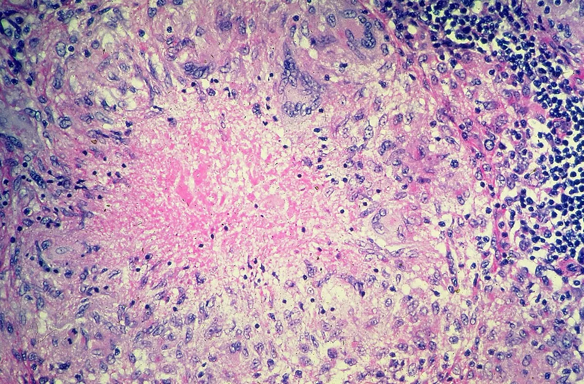 Tuberkulose – Histologie (HE): nekrotisierendes Granulom mit zentraler (verkäsender) Nekrose, Saum aus Epitheloidzellen und Lymphozyten