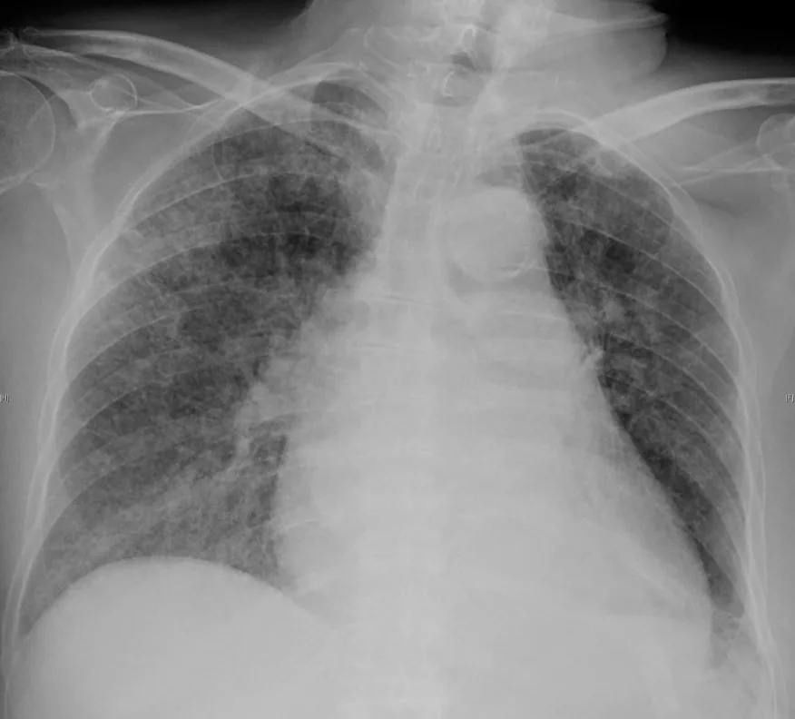 Tuberkulose – Röntgen-Thorax: Miliartuberkulose mit diffus über beide Lungen verteilten feinen Knötchen und interstitieller Zeichnung
