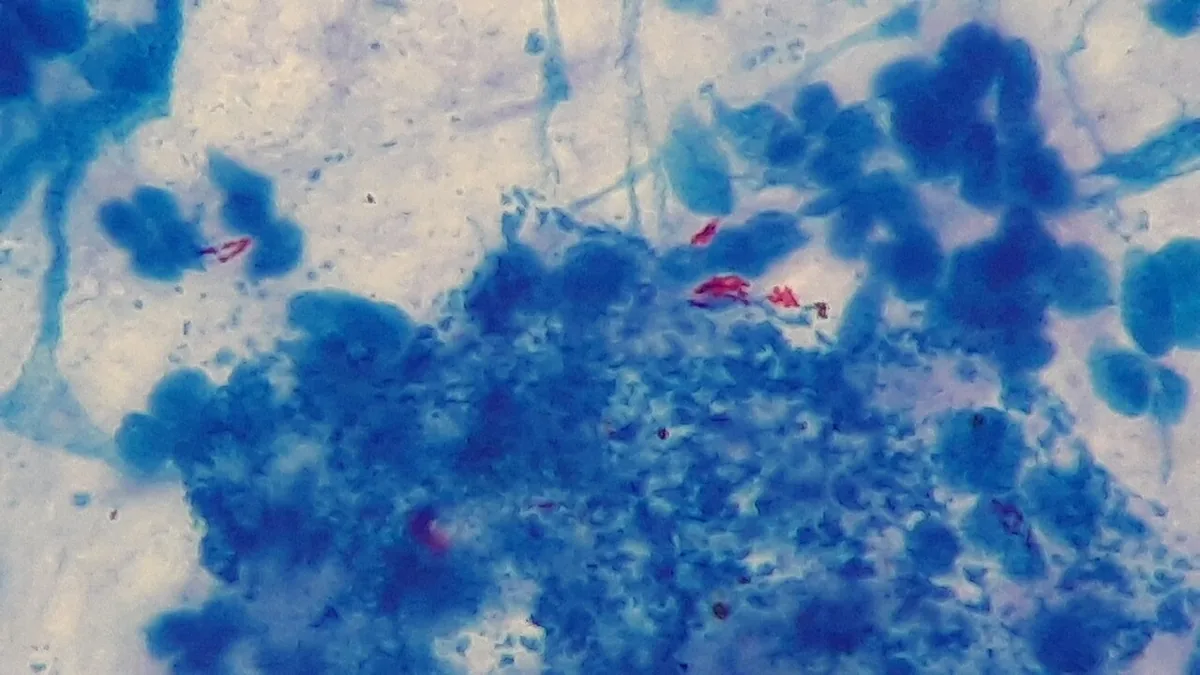 Tuberkulose – Blutausstrich/Zytologie: Ziehl-Neelsen-Färbung von Sputum: rot gefärbte, schlanke säurefeste Stäbchen vor blauem Hintergrund