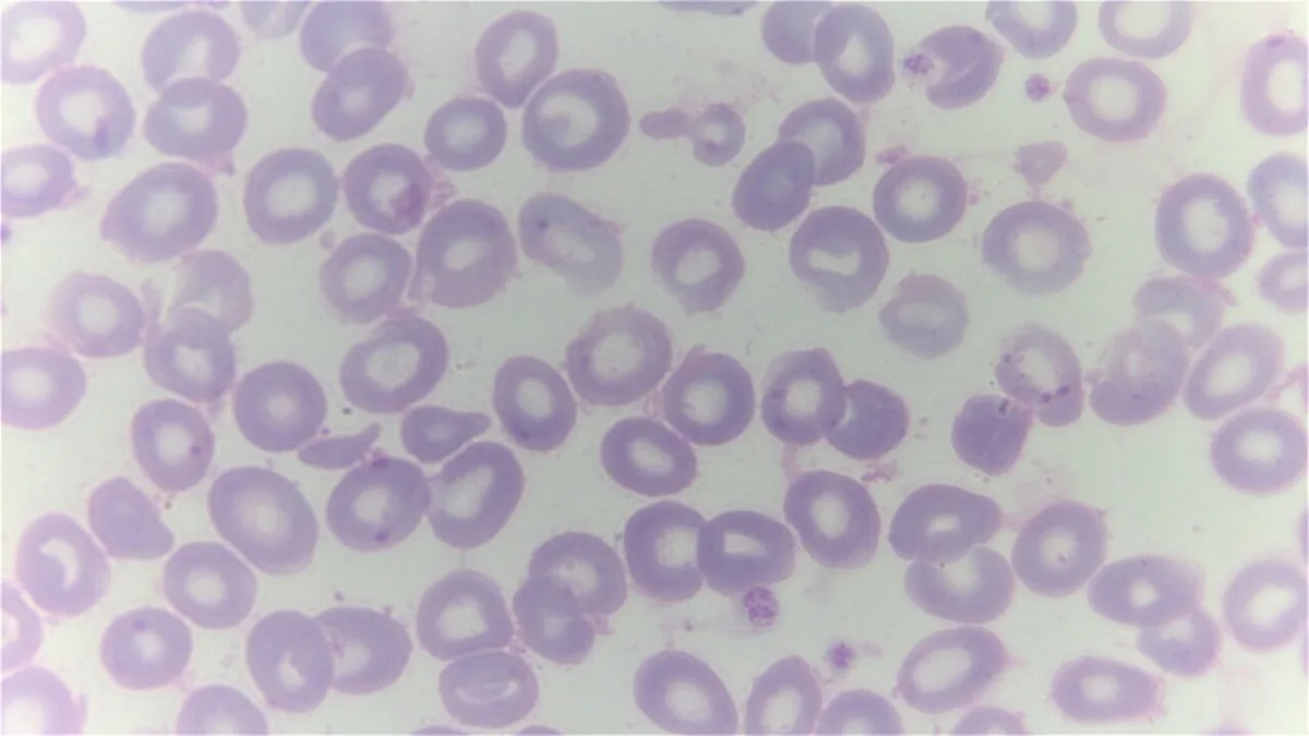 Thalassemia – Blood smear in beta thalassemia: pale, hypochromic red cells with wide central pallor and shape variation