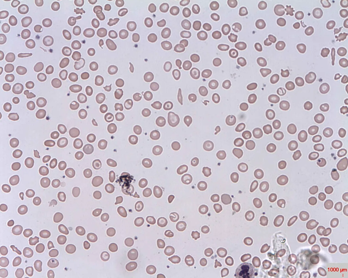 Thalassemia – Blood smear: many codocytes (bull’s-eye cells) with a central hemoglobin spot, plus poikilocytosis