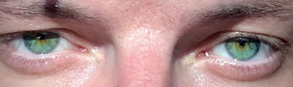 Toxidromes (recognizing poisoning) – clinical photo: Opioid toxidrome: pinpoint pupils (miosis) and drooping upper eyelids on both sides with sedation