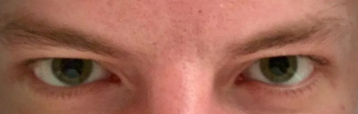 Toxidromes (recognizing poisoning) – clinical photo: Dilated pupils (mydriasis) after hallucinogen use (LSD) – a key sign of sympathomimetic and anticholinergic poisoning patterns