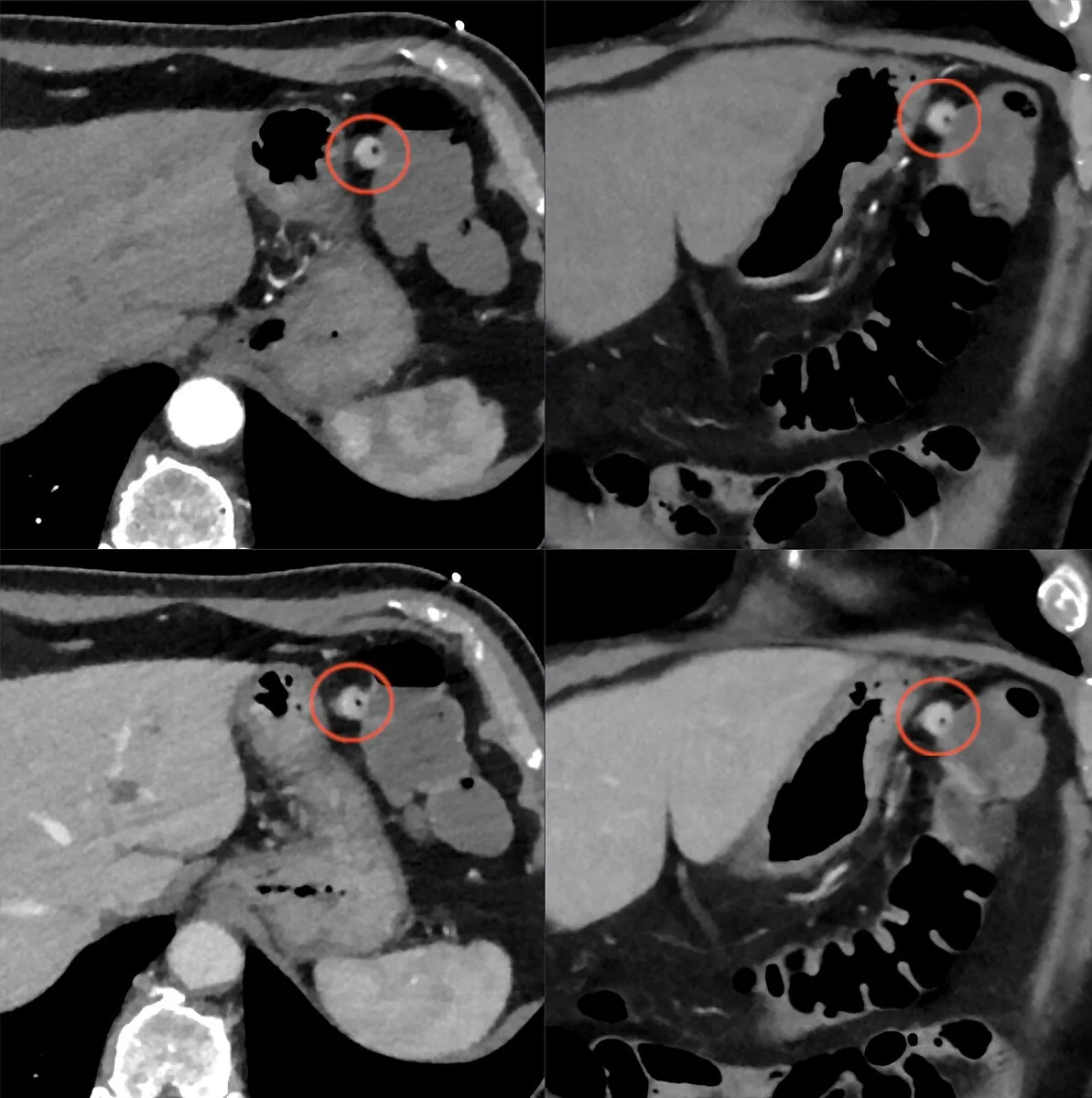 Lower gastrointestinal bleeding – Contrast-enhanced CT: diverticulum at the splenic flexure with hyperdense contrast in the lumen (circle), arterial and portal venous phase