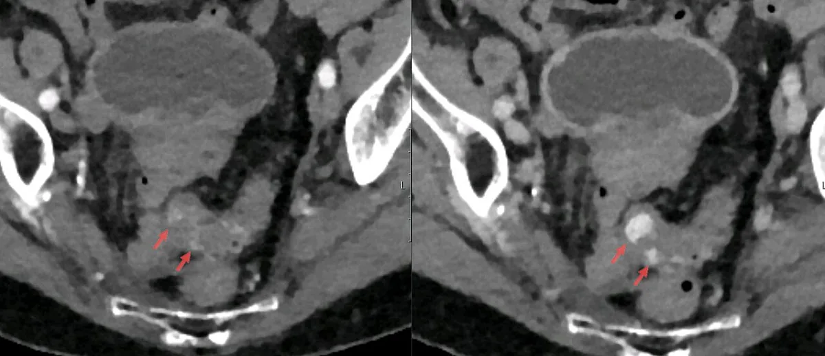 Lower gastrointestinal bleeding – Contrast-enhanced CT: active diverticular bleeding in the sigmoid – the contrast blush (arrows) grows from arterial to portal venous phase