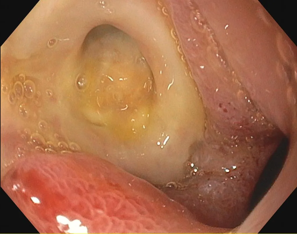Peptic ulcer disease (stomach ulcer) – endoscopy: Duodenoscopy: round bulbar ulcer with a clean fibrin base (Forrest III)