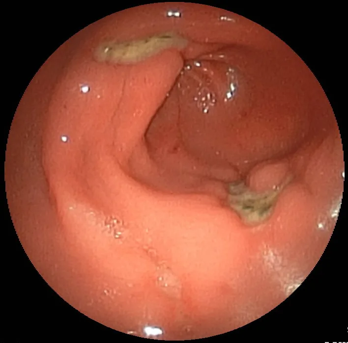 Peptic ulcer disease (stomach ulcer) – endoscopy: Gastroscopy: two fibrin-covered ulcers in the gastric antrum