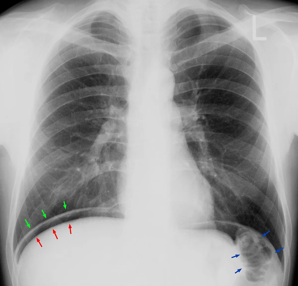 Peptic ulcer disease (stomach ulcer) – Upright chest X-ray: free air as a crescent between the upper liver border (red arrows) and diaphragm (green arrows) after visceral perforation