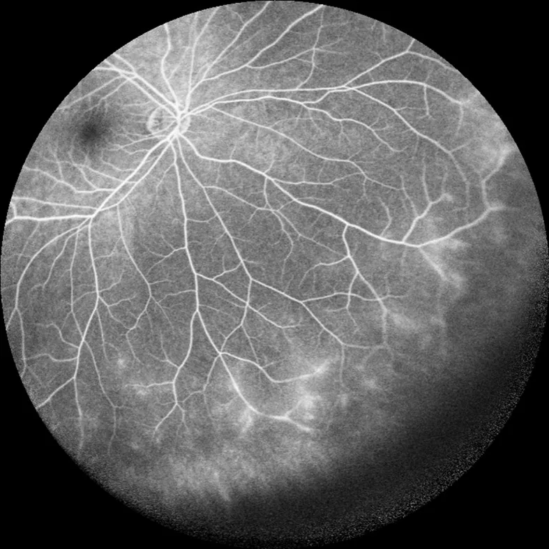 Uveitis in rheumatic diseases – Ultra-wide-field fluorescein angiography in active uveitis: dye leakage from peripheral retinal vessels