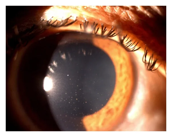 Uveitis in rheumatic diseases – clinical photo: Slit lamp with retro-illumination in anterior uveitis: numerous fine, punctate keratic precipitates