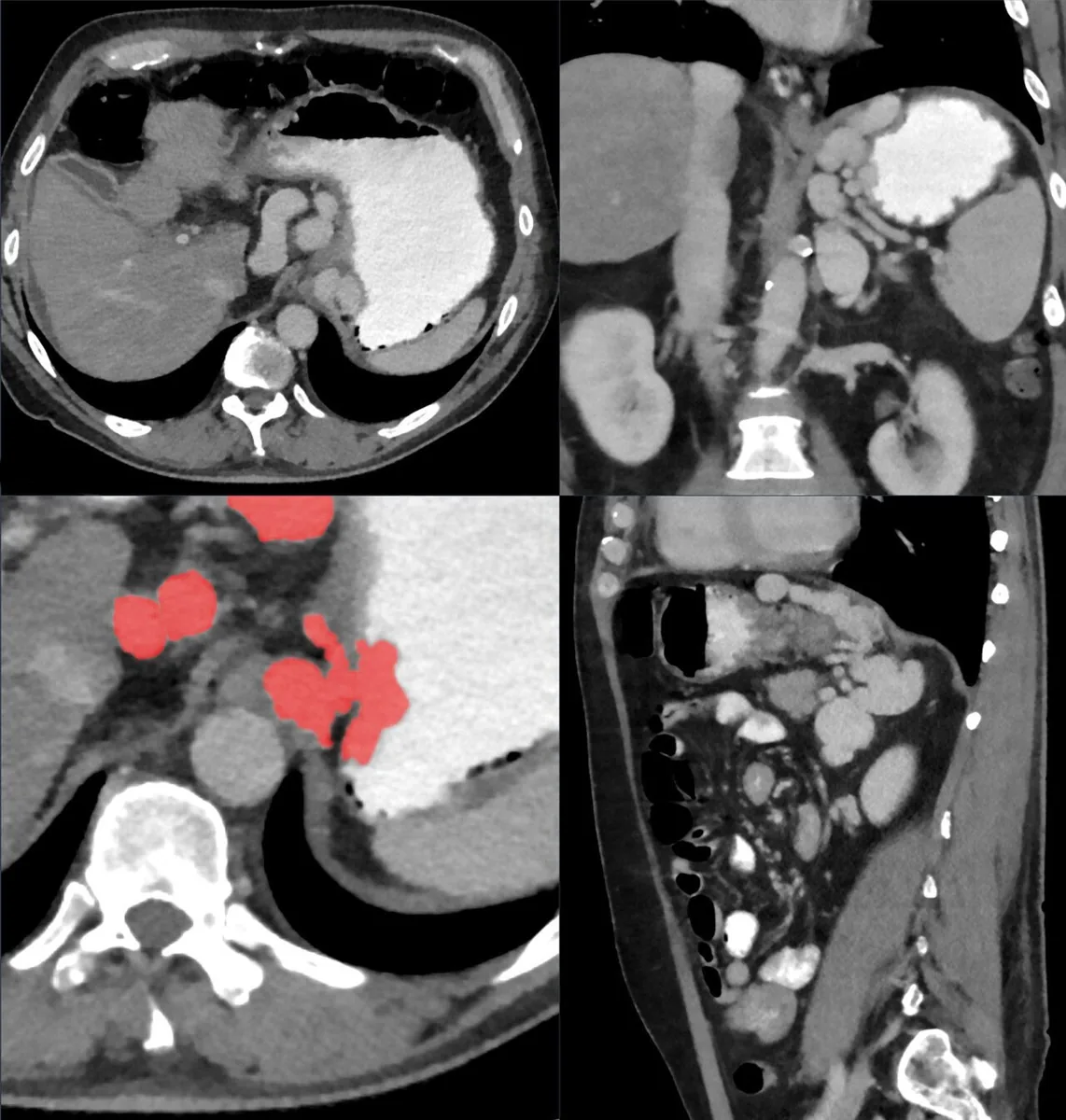 Esophageal varices and portal hypertension – Contrast CT: voluminous portosystemic collaterals along the lesser curvature of the stomach (marked in red)