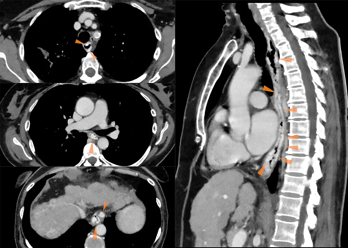 Esophageal varices and portal hypertension – Contrast CT (portal venous phase, axial and sagittal): extensive, long-segment esophageal varices in liver cirrhosis (arrowheads)