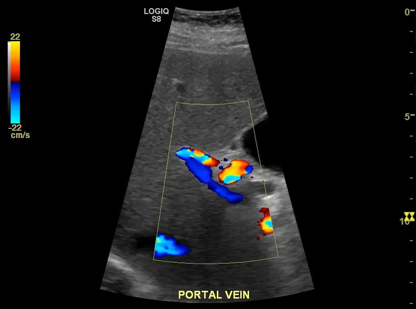 Esophageal varices and portal hypertension – Color Doppler ultrasound in liver cirrhosis: hepatofugal flow (directed away from the liver) in the portal vein, a sign of portal hypertension