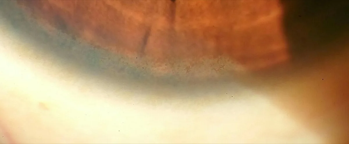 Wilson's disease – clinical photo: Close-up: greenish-brown Kayser-Fleischer ring at the lower corneal margin in Wilson's disease
