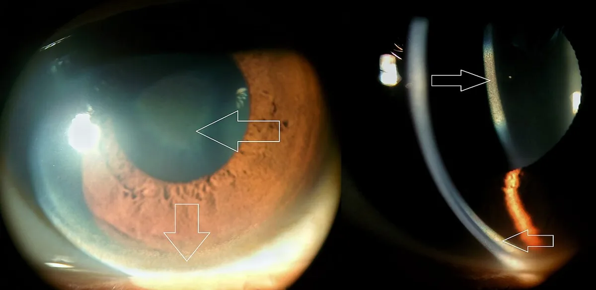 Wilson's disease – clinical photo: Slit lamp in Wilson's disease: Kayser-Fleischer ring (copper deposition at the corneal margin) and sunflower cataract (arrows)