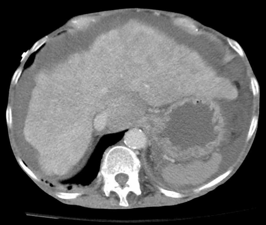 Liver cirrhosis – Abdominal CT: shrunken liver with an undulating, nodular contour surrounded by ascites