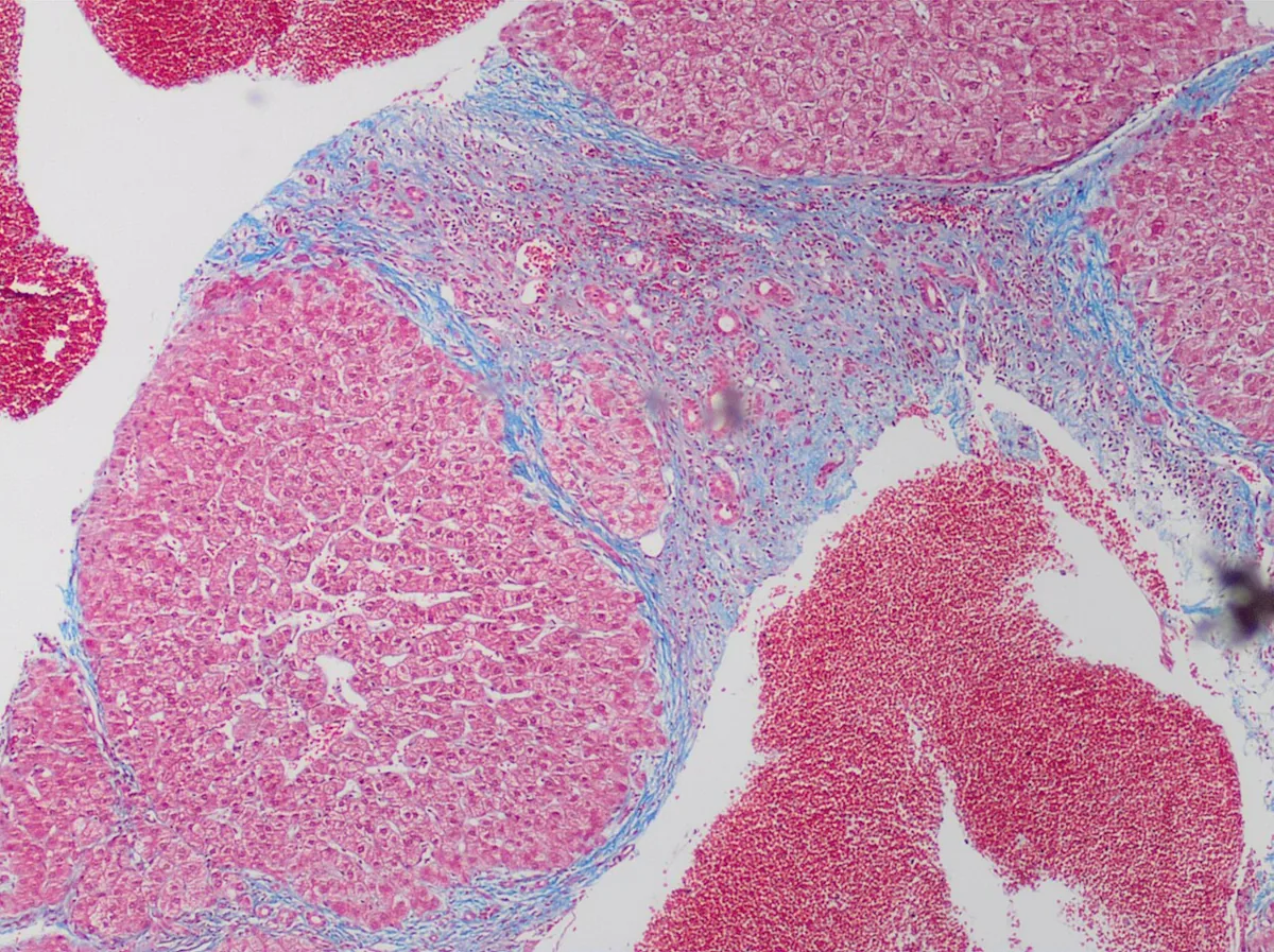 Liver cirrhosis – Histology (trichrome stain): blue-stained fibrous septa encircling round regenerative nodules of hepatocytes