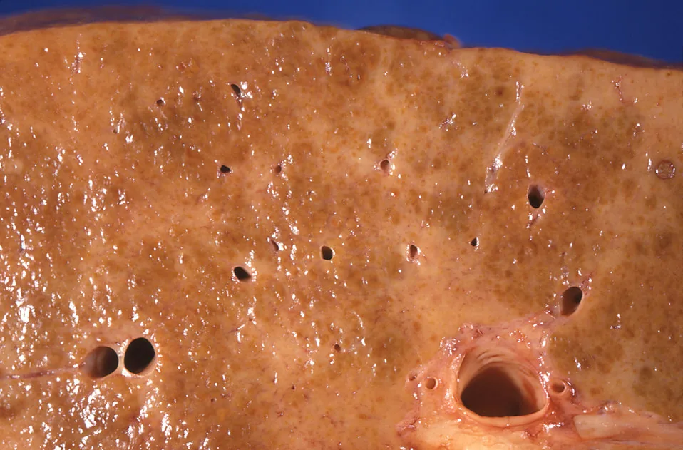 Liver cirrhosis – gross specimen: Cut surface of alcoholic liver cirrhosis: small regenerative nodules surrounded by a dense, pale network of scar tissue
