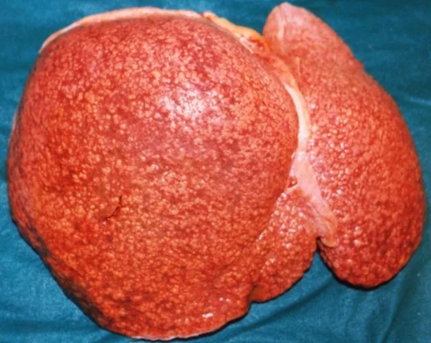Liver cirrhosis – Gross specimen: micronodular liver cirrhosis with a uniformly finely nodular surface (alcohol-related)