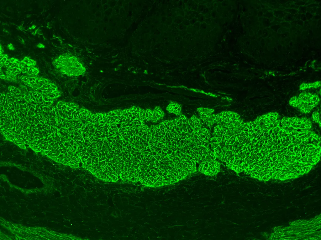 Celiac disease (gluten intolerance) – Indirect immunofluorescence: honeycomb staining of smooth muscle by endomysial antibodies in patient serum
