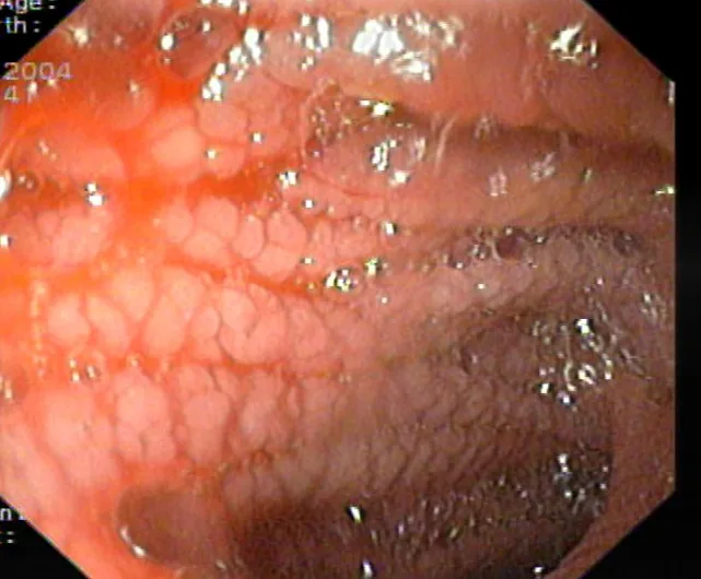 Celiac disease (gluten intolerance) – endoscopy: Duodenoscopy: mosaic pattern and flattened folds of the duodenal mucosa