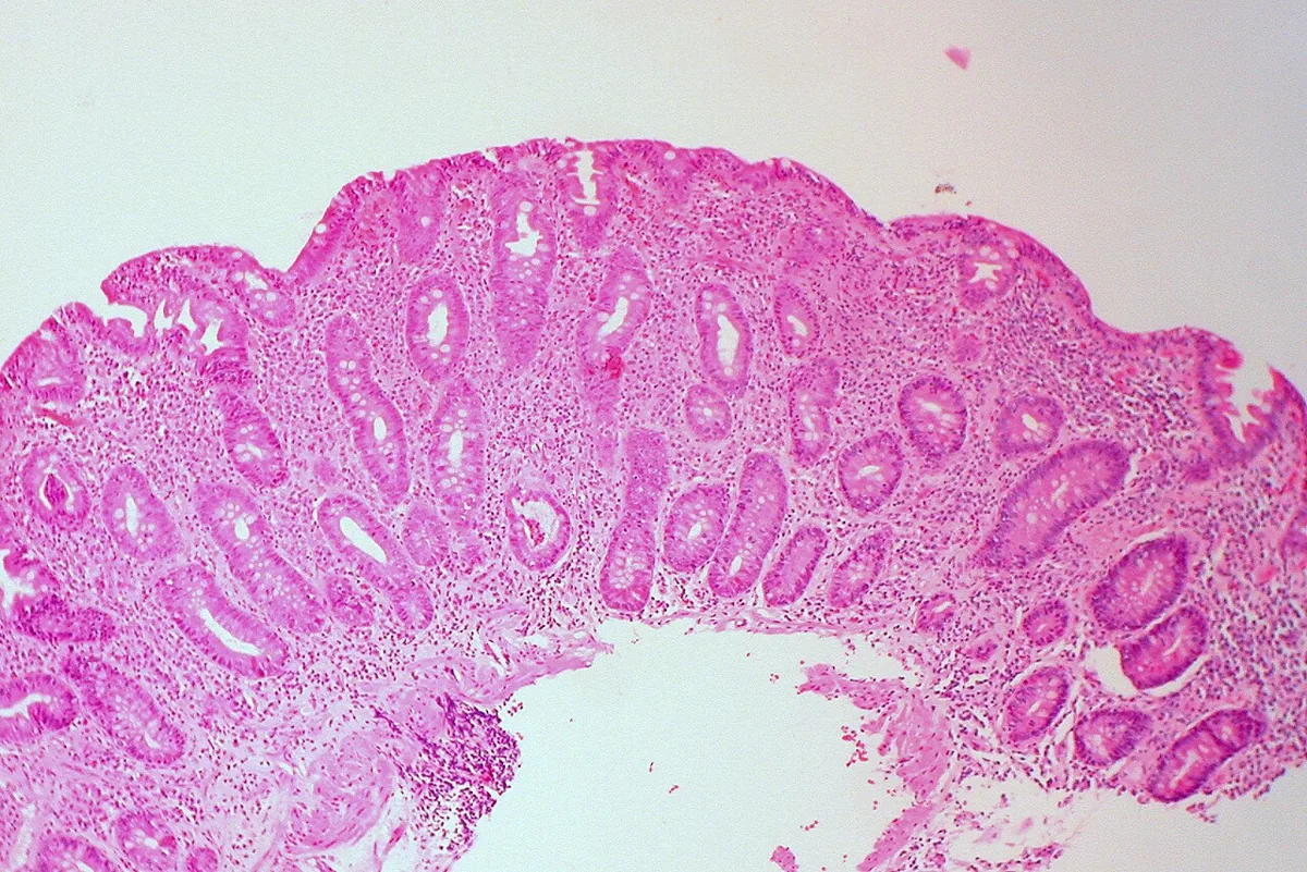 Celiac disease (gluten intolerance) – Small-bowel biopsy (H&E): total villous atrophy with elongated crypts and increased inflammatory cells (Marsh 3)