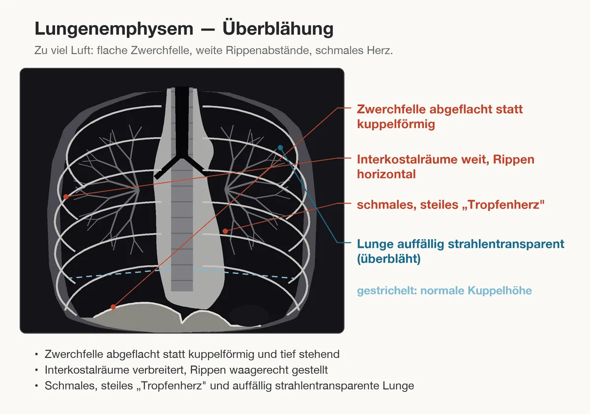 COPD (chronisch obstruktive Lungenerkrankung) – Schema (Zeichnung): Zeichnung: Röntgenzeichen der Überblähung – abgeflachte Zwerchfelle, horizontale Rippen, schmales Tropfenherz, strahlentransparente Lunge