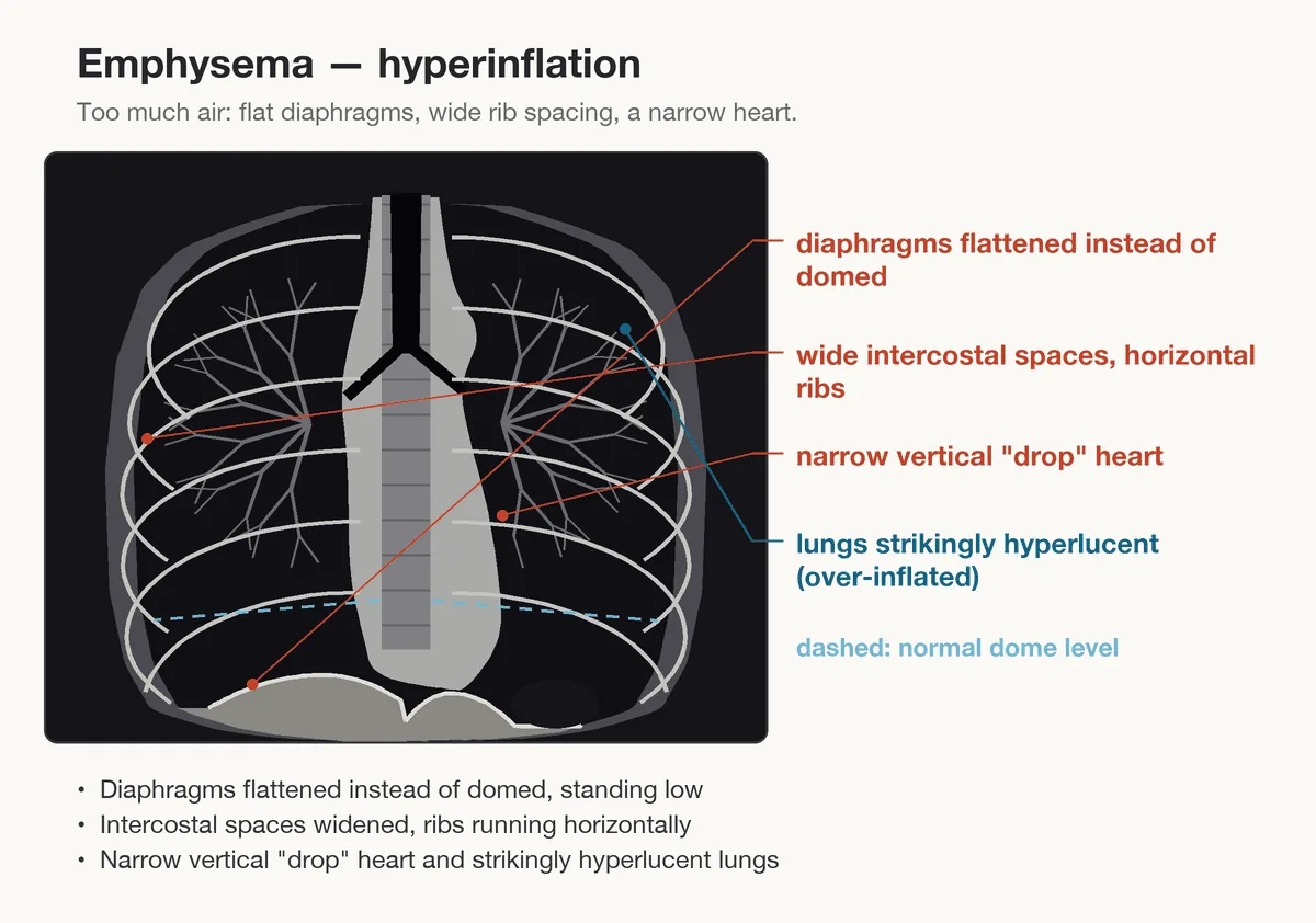 COPD (chronic obstructive pulmonary disease) – diagram: Diagram: radiographic signs of hyperinflation – flattened diaphragms, horizontal ribs, narrow teardrop heart, hyperlucent lungs