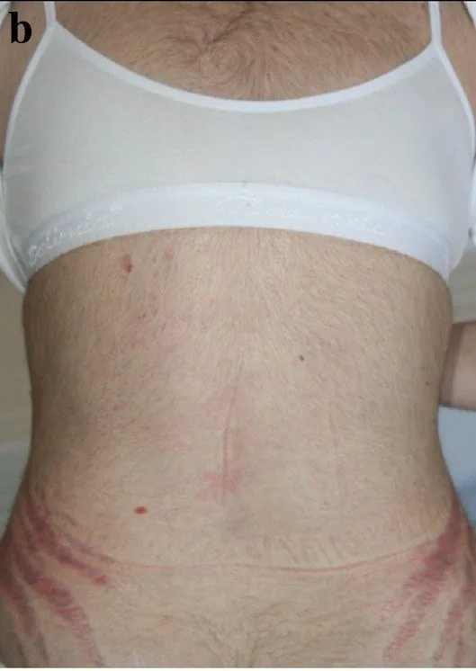 Cushing's syndrome – clinical photo: Reddish striae on the lower abdomen and increased truncal hair in iatrogenic Cushing's syndrome