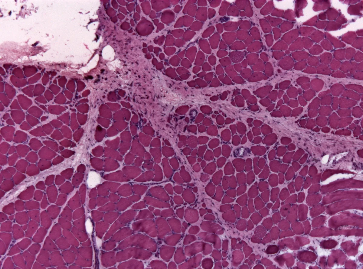 Dermatomyositis and polymyositis – Histology in dermatomyositis