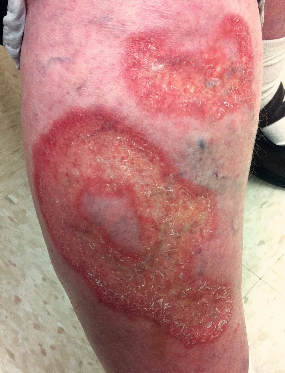 Type 1 diabetes mellitus – clinical photo: Necrobiosis lipoidica on the lower leg: yellowish atrophic plaques with a raised reddish-violaceous border