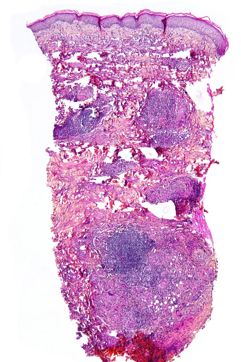 Type 1 diabetes mellitus – Histology of necrobiosis lipoidica (H&E): layered granulomas and degenerated collagen throughout the dermis