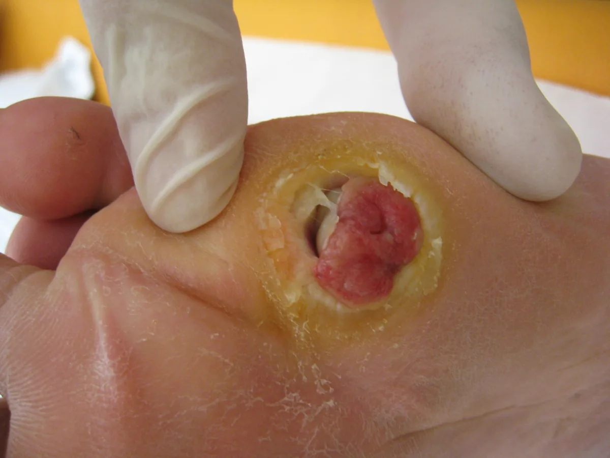 Diabetic polyneuropathy – foot – clinical photo: Neuropathic ulcer (malum perforans) on the sole: round defect with a thick callus rim at a pressure point