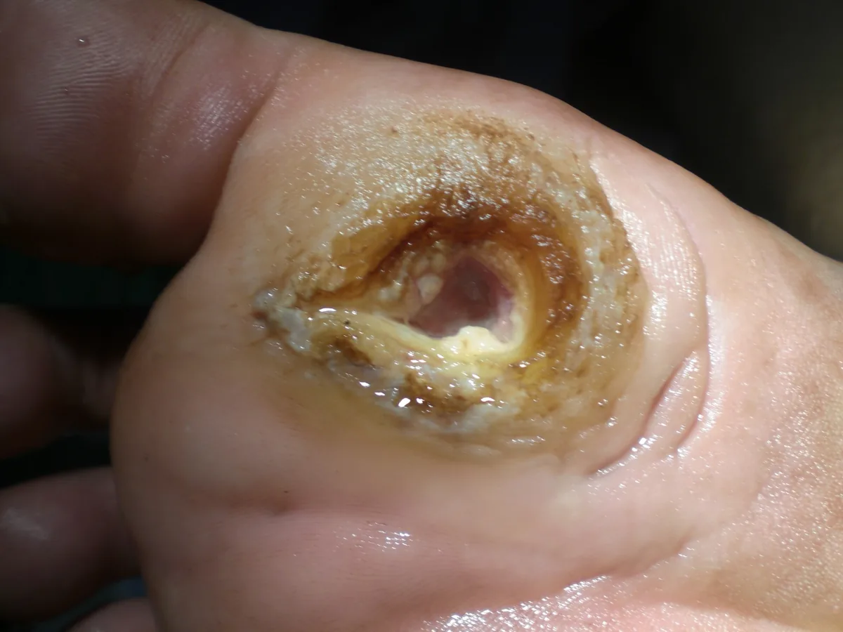 Diabetic foot syndrome – clinical photo: Diabetic foot ulcer on the sole