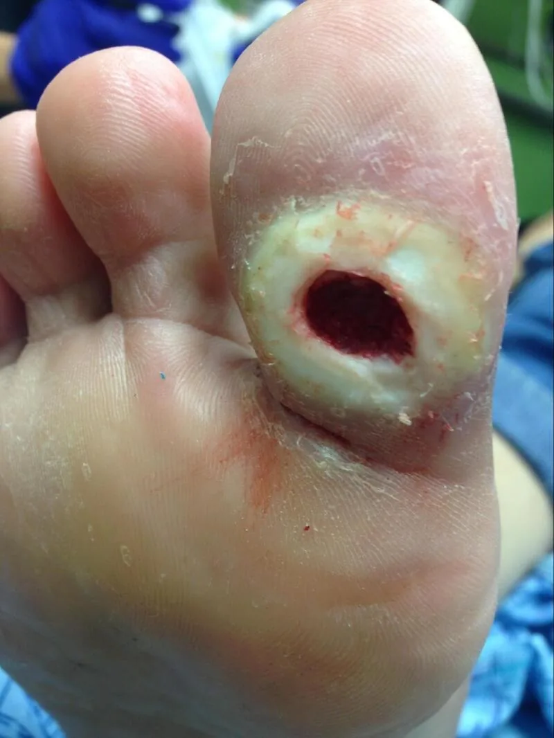 Diabetic foot syndrome – clinical photo: Diabetic ulcer on a toe