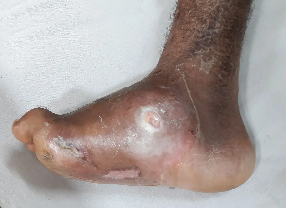 Diabetic foot syndrome – clinical photo: Charcot foot: collapse of the arch with rocker-bottom deformity, swelling and ulcer over the sole