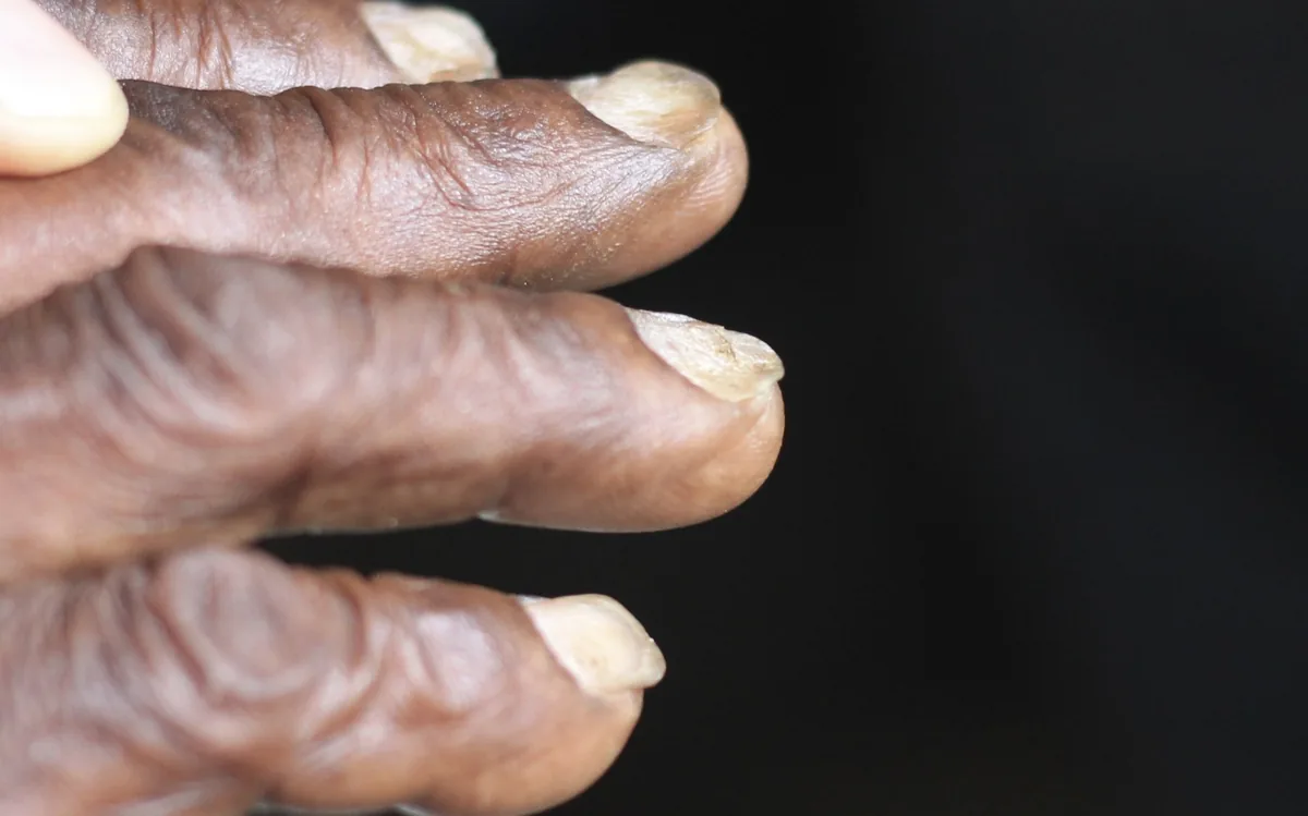 Iron deficiency anemia – clinical photo: Koilonychia (spoon nails)