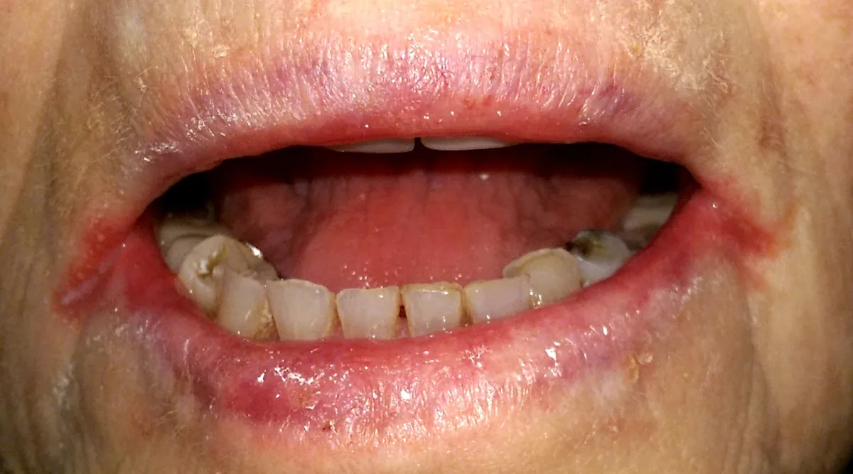 Iron deficiency anemia – clinical photo: Angular cheilitis: red fissures at both corners of the mouth