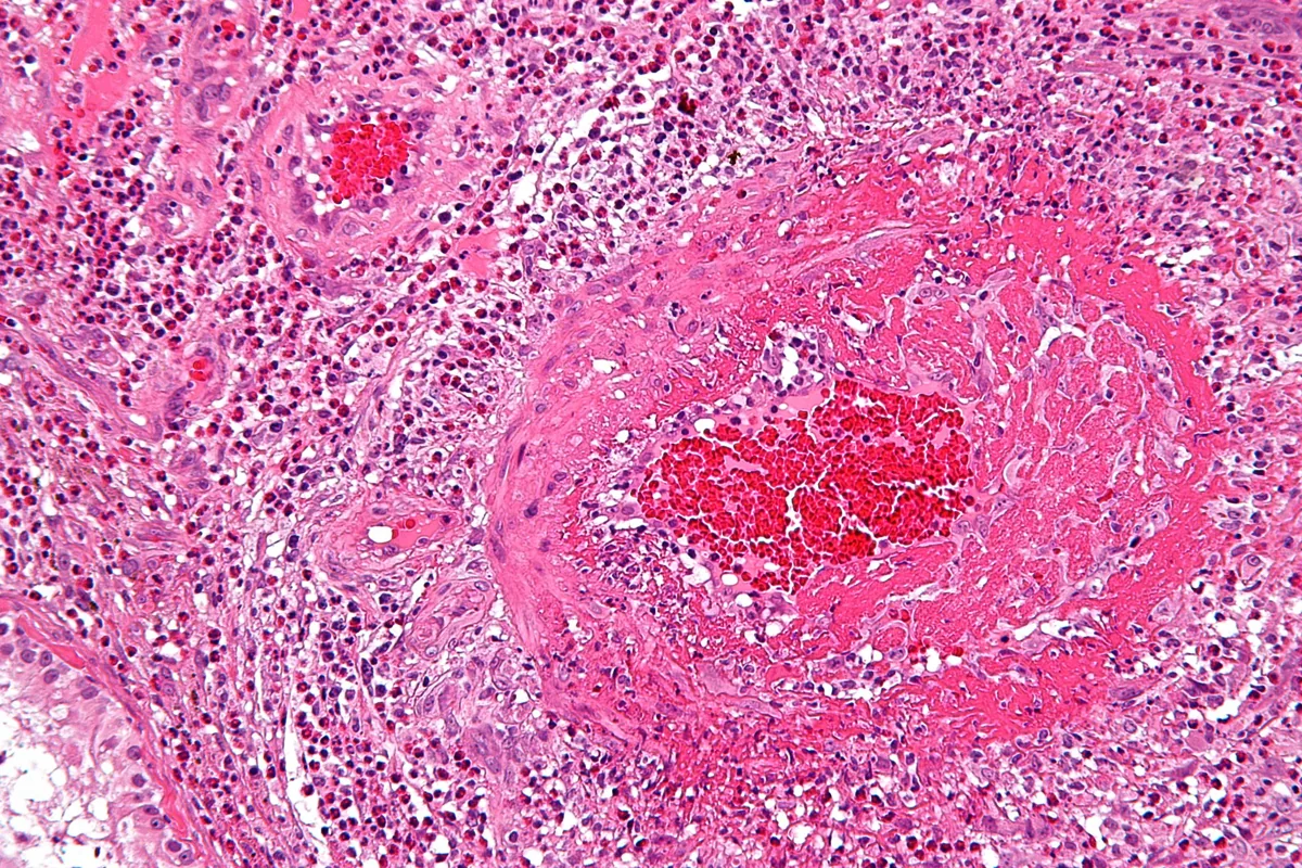 Eosinophile Granulomatose mit Polyangiitis (EGPA, Churg-Strauss) – Histologie bei EGPA mit eosinophilen Infiltraten