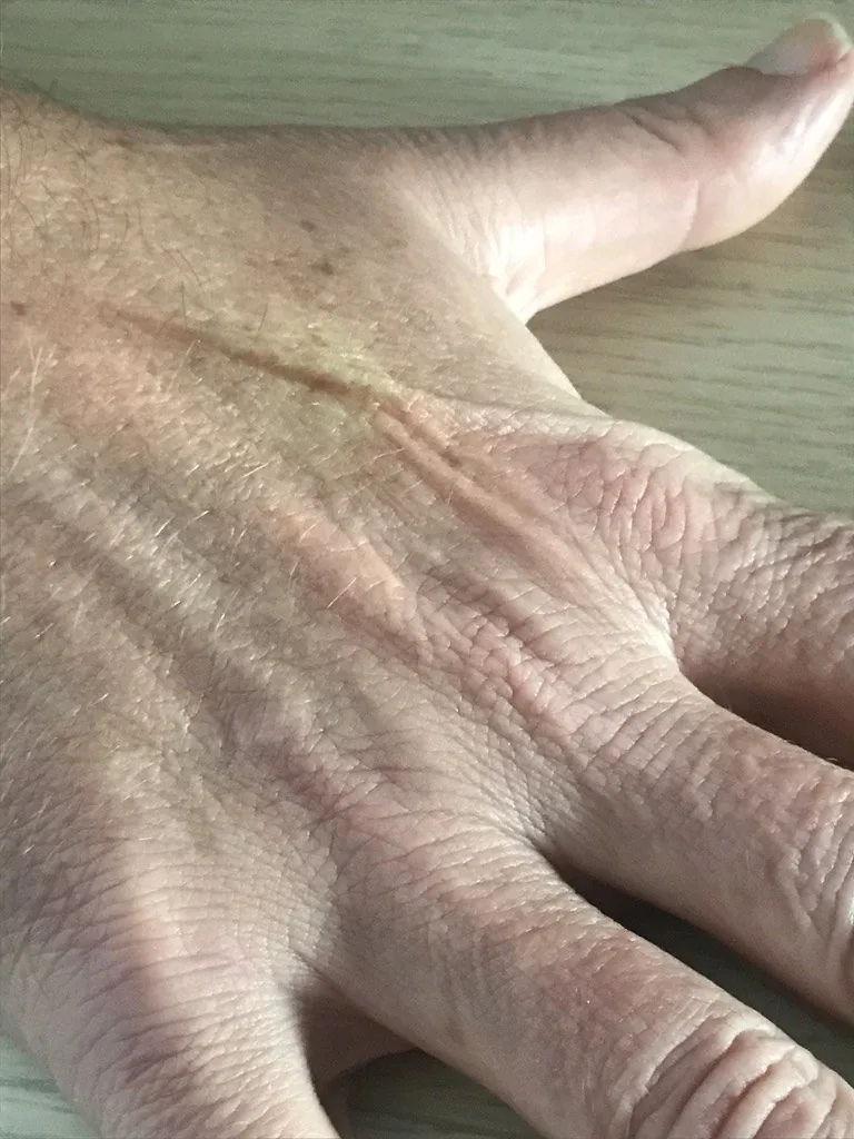 Dehydration – clinical photo: Persistent skin tenting in dehydration