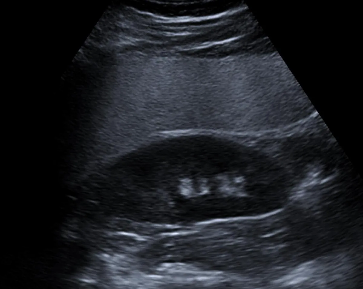 Steatotic liver disease (fatty liver, MASLD) – Ultrasound: hyperechoic liver in steatosis