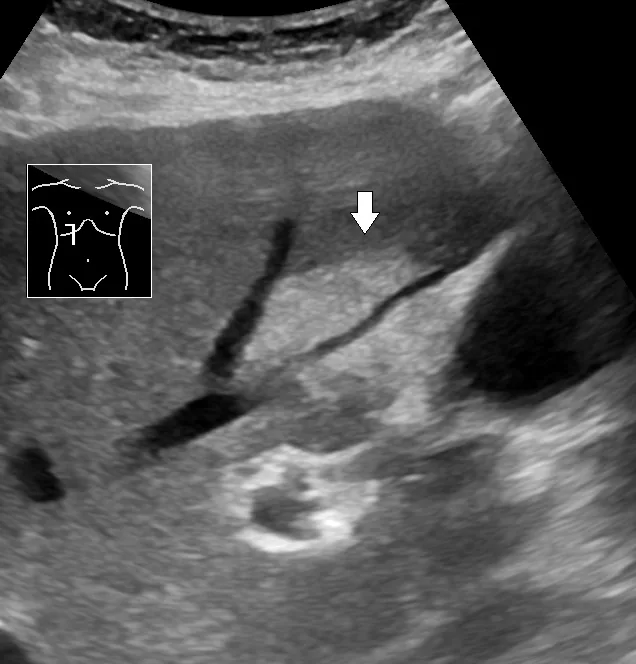 Steatotic liver disease (fatty liver, MASLD) – Ultrasound: focal fatty infiltration