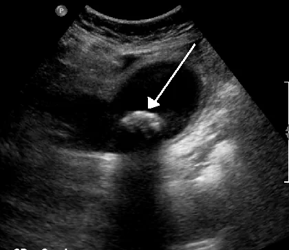Cholezystolithiasis und akute Cholezystitis (Gallensteine) – Sonographie: Gallenstein mit dorsalem Schallschatten