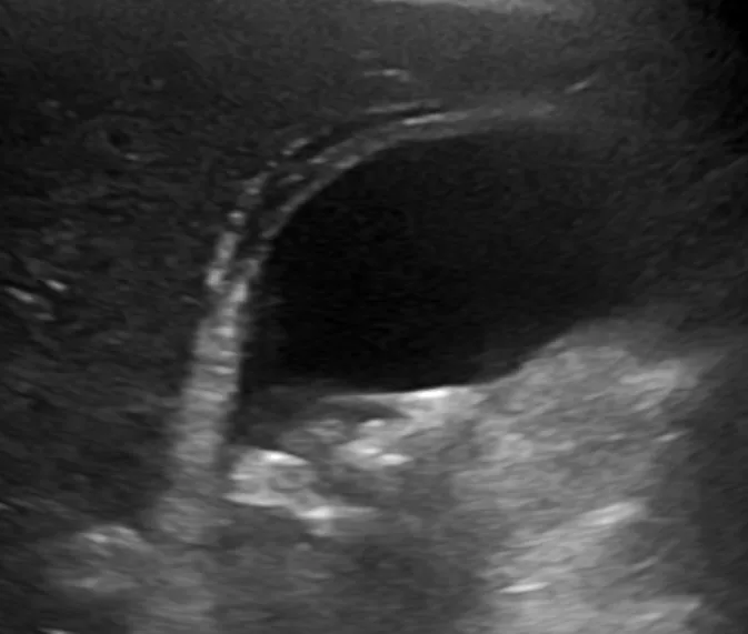 Cholezystolithiasis und akute Cholezystitis (Gallensteine) – Sonographie bei akuter Cholezystitis