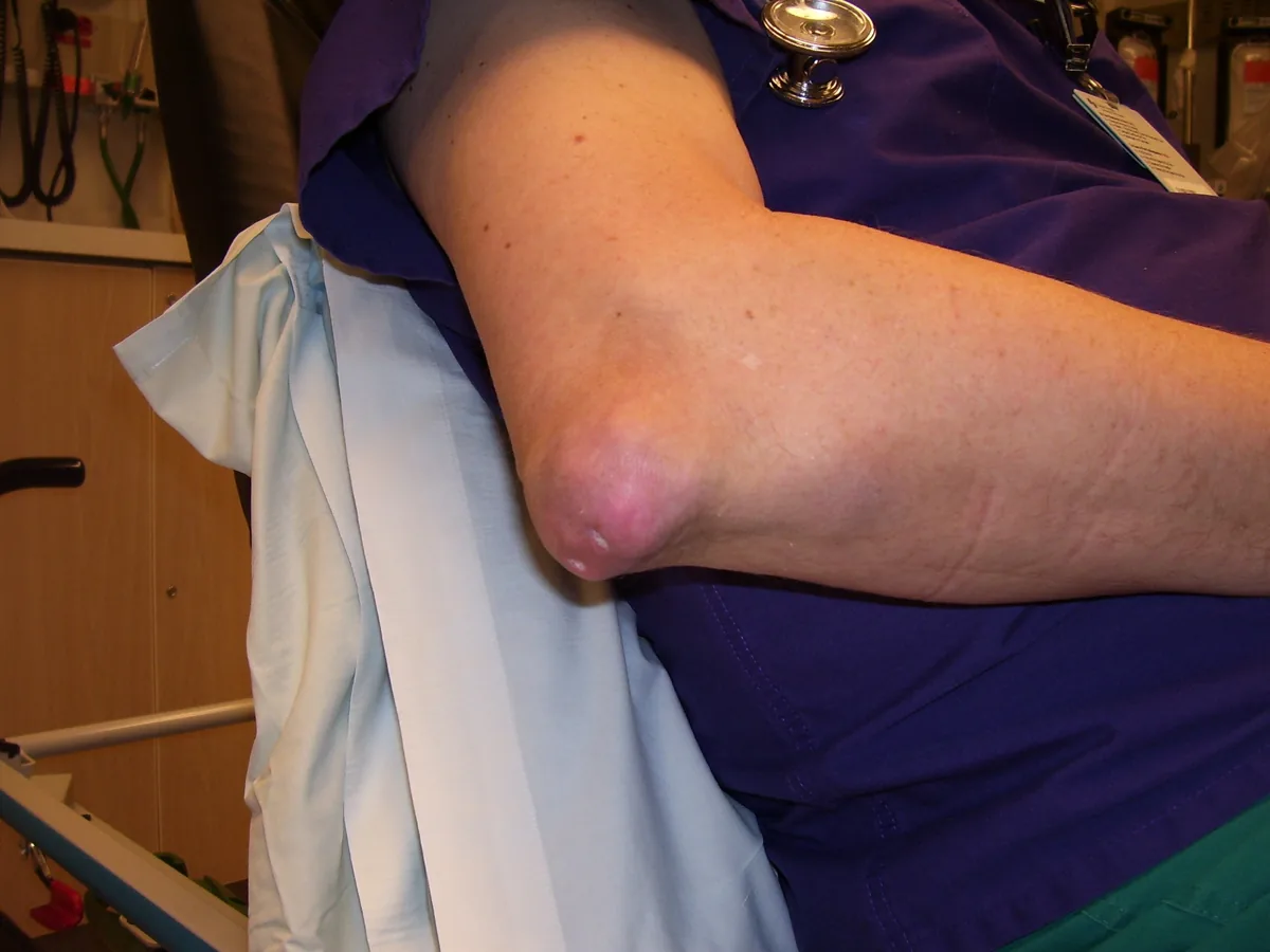 Gout – clinical photo: Gouty tophus at the elbow