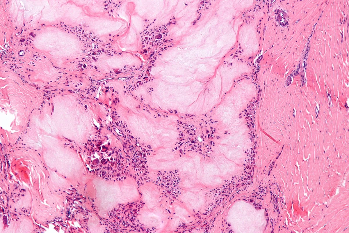 Gout – Histology of a gouty tophus
