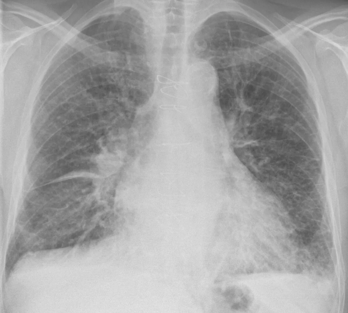Herzinsuffizienz (Herzschwäche) – Röntgen-Thorax: pulmonalvenöse Stauung