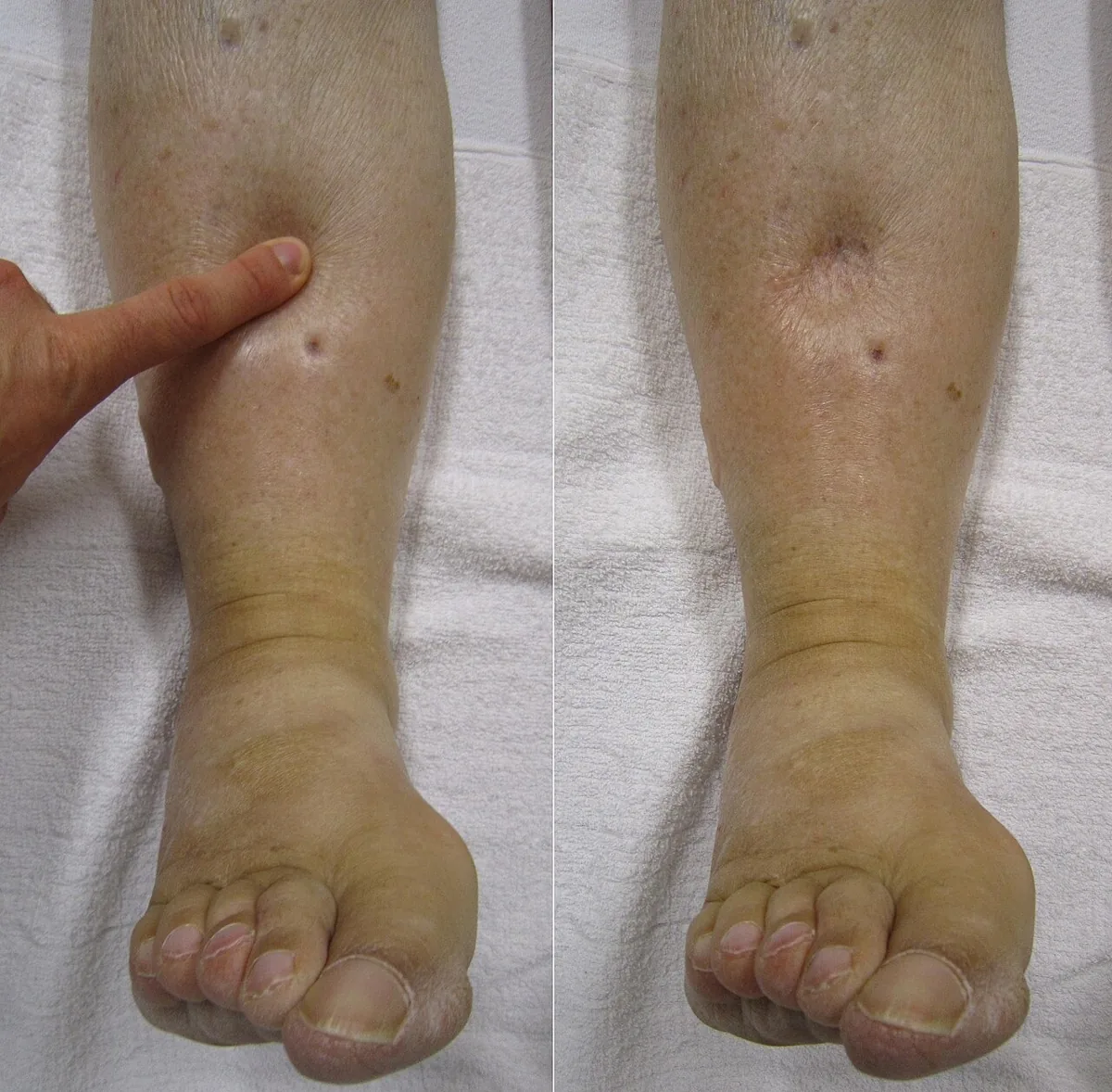 Herzinsuffizienz (Herzschwäche) – Bein – klinisches Foto: Eindrückbares (Pitting-)Ödem am Unterschenkel