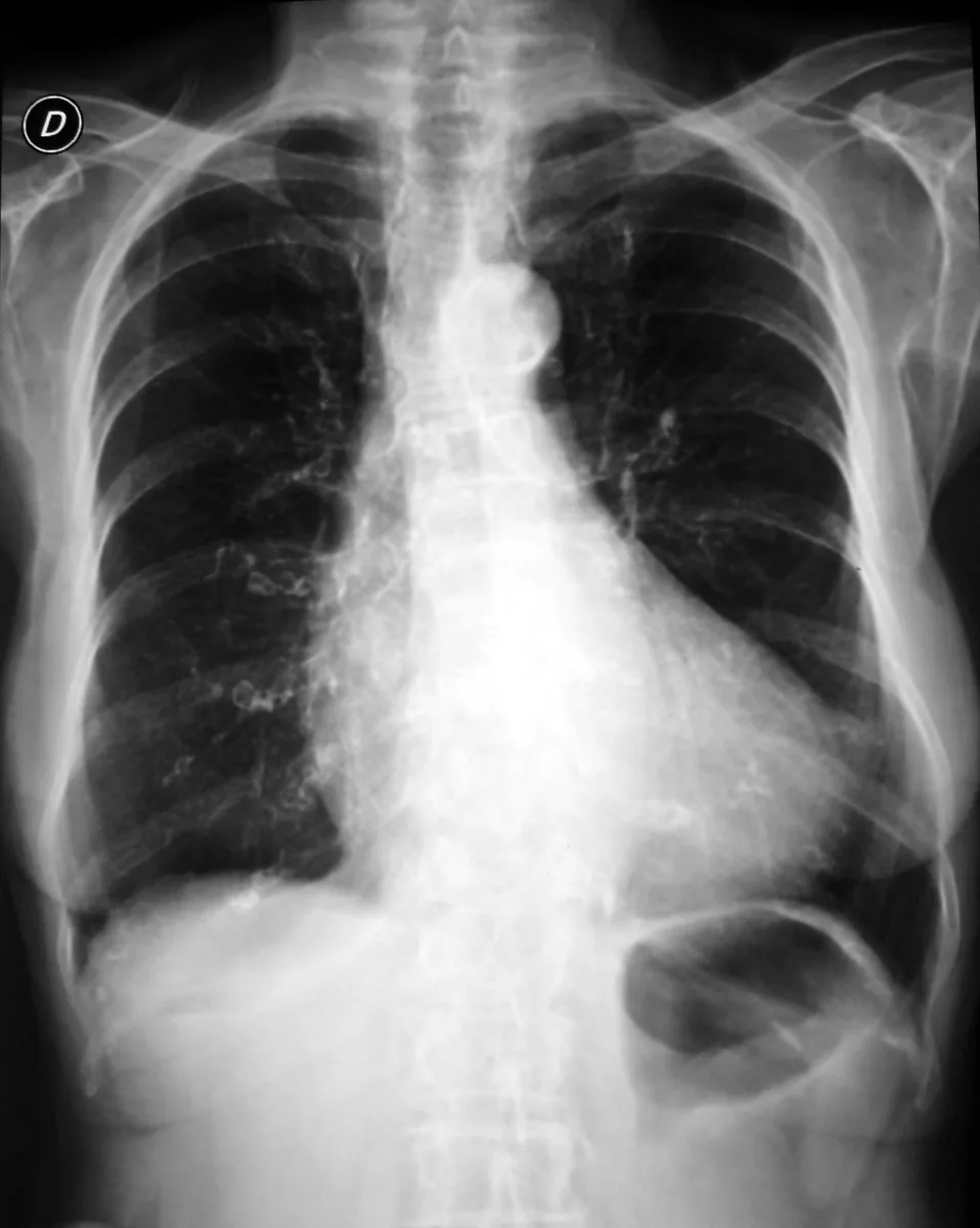Herzinsuffizienz (Herzschwäche) – Röntgen-Thorax: vergrößerter Herzschatten
